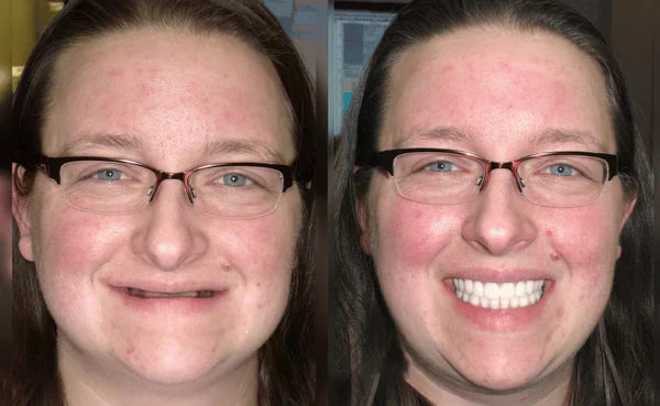 Custom-Fit Functional Dentures